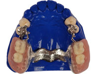 attachmentdenture