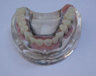 Denture001